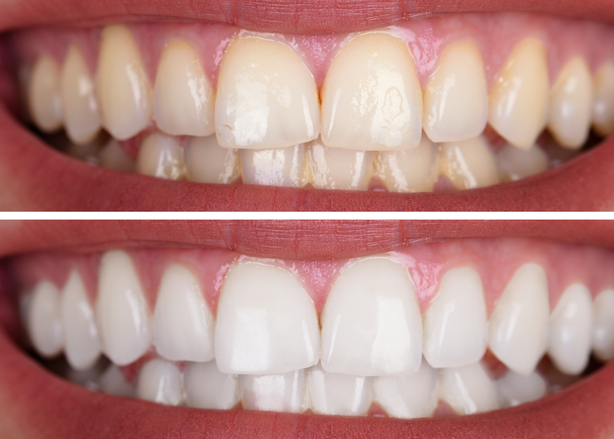 The MySmile Whitening Process