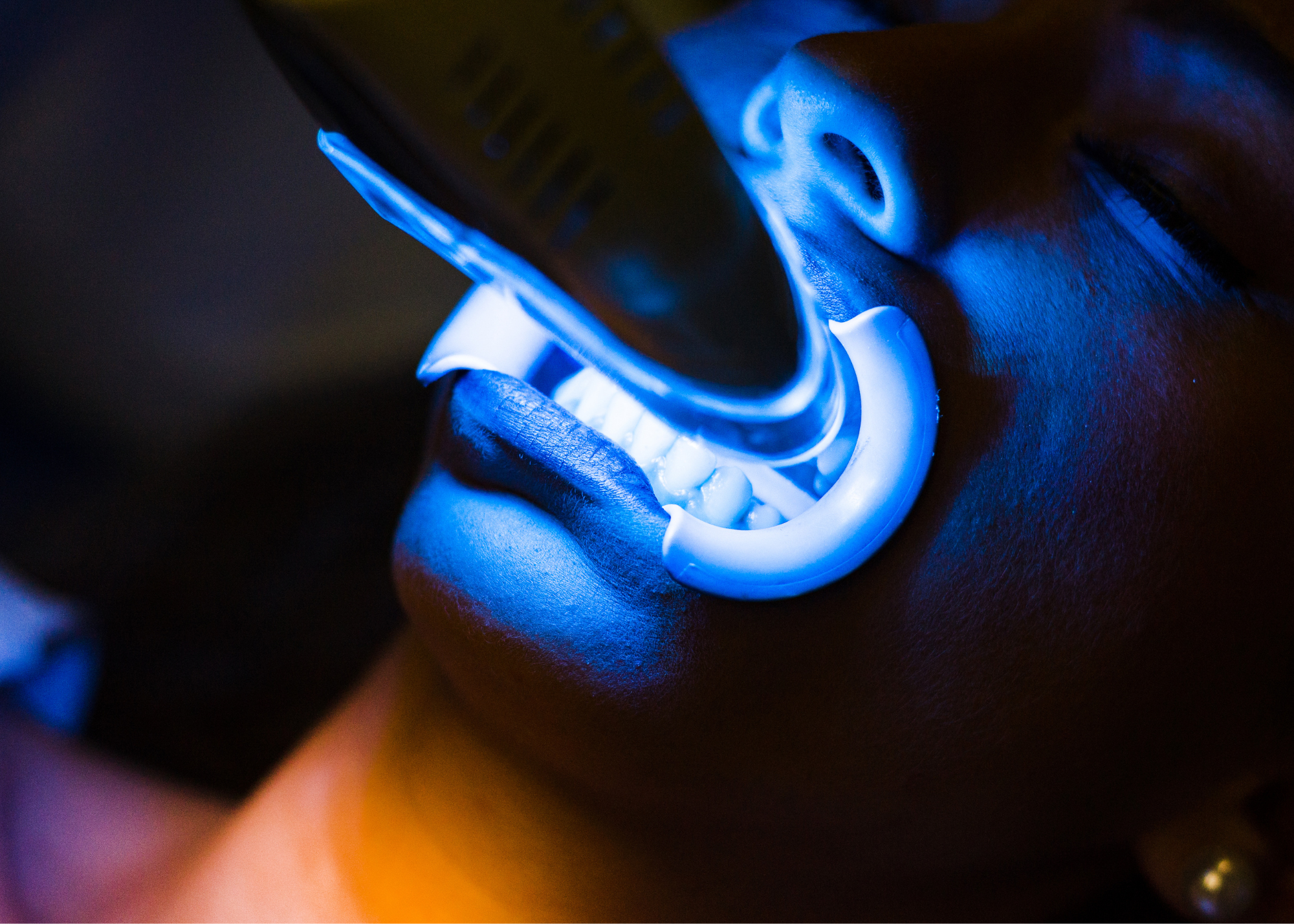 Revealing the Bright Side of MySmile Teeth Whitening Strips