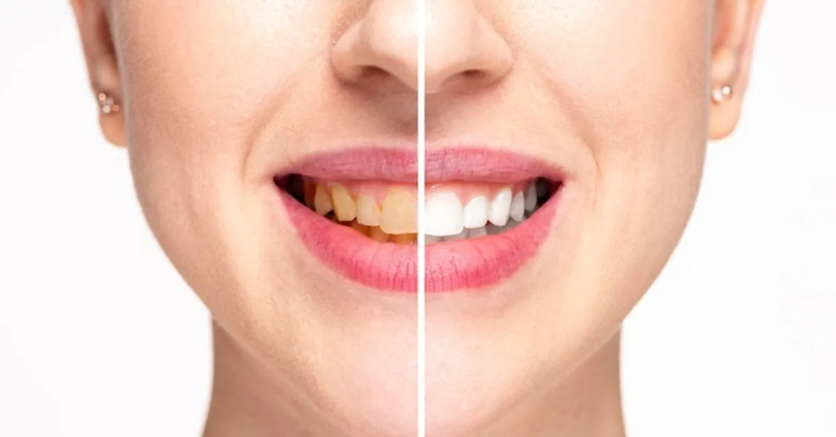 How To Whiten Your Teeth Naturally in Just 3 Minutes