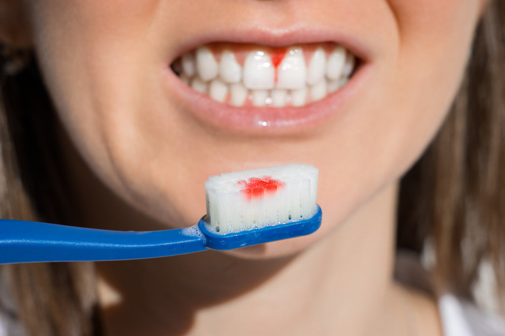 Why Do My Teeth Bleed When I Floss?