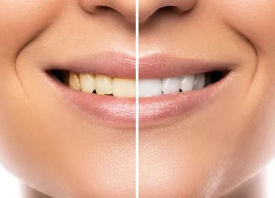 brighter smile with effective teeth whitening solutions