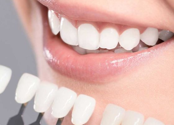 what is the best teeth whitening