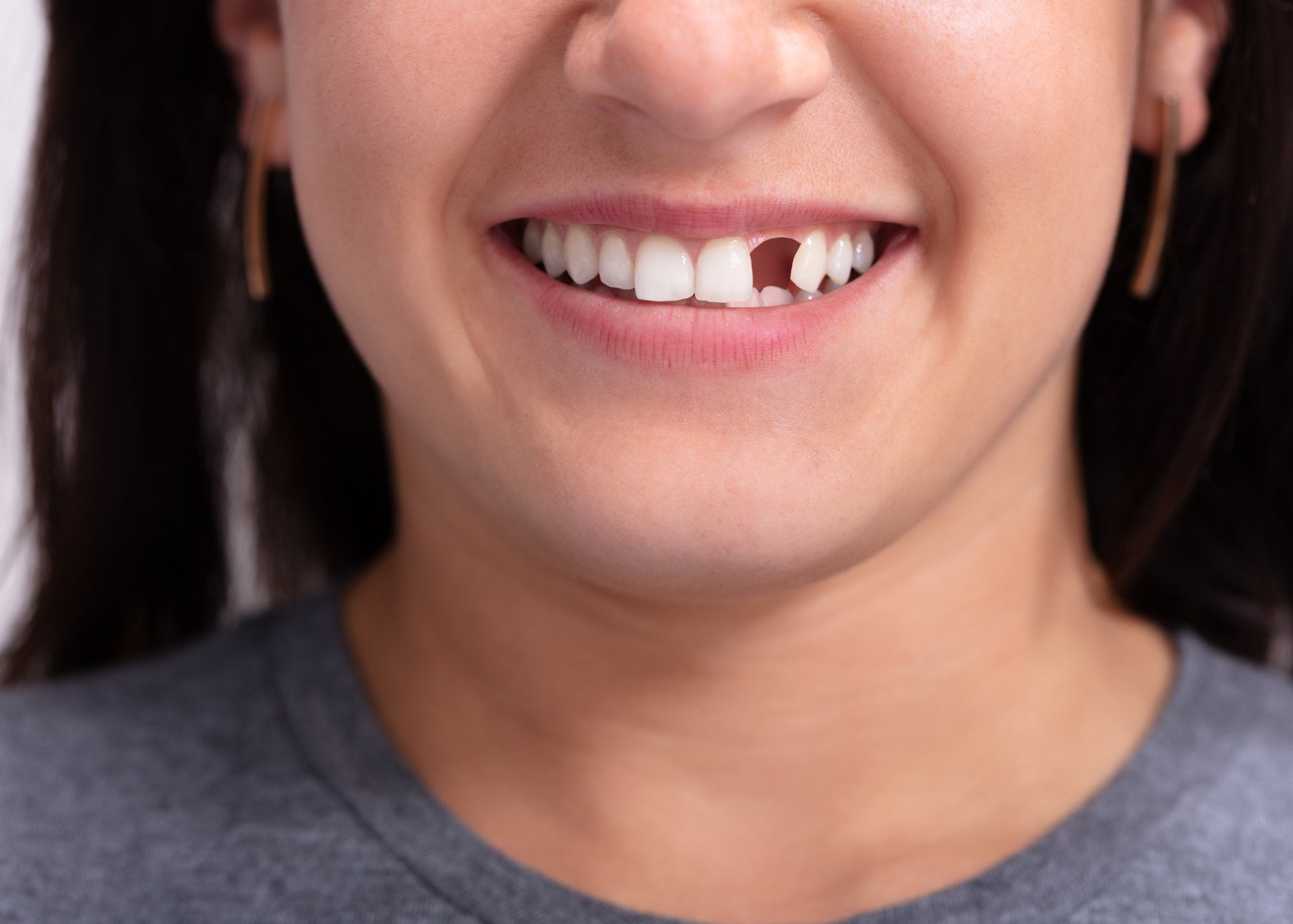 Exploring Modern Solutions for Missing Teeth - MySmile