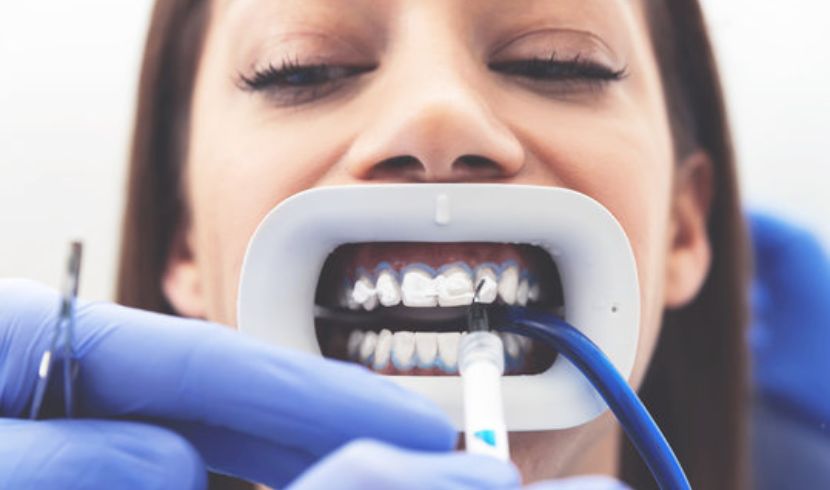 how to use teeth whitening gel