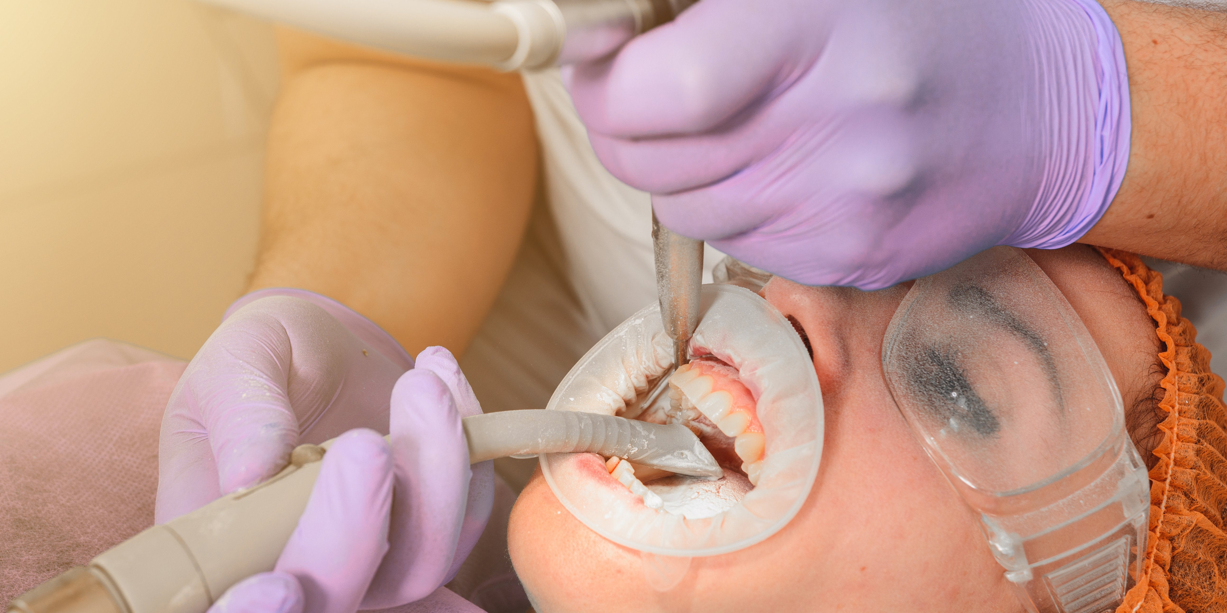 Professional Teeth Cleaning: Removing Plaque and Tartar Buildup - MySmile