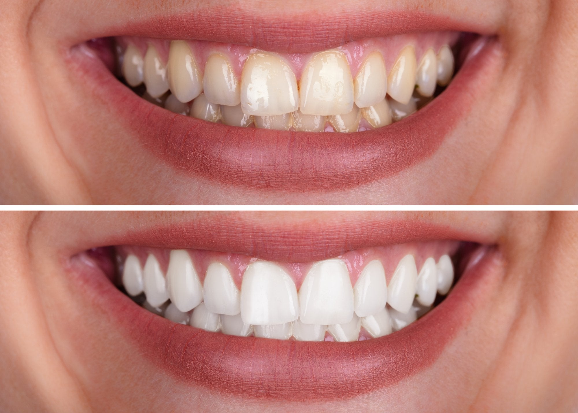 Psychological Impact of Color Correction on Self-esteem - MySmile