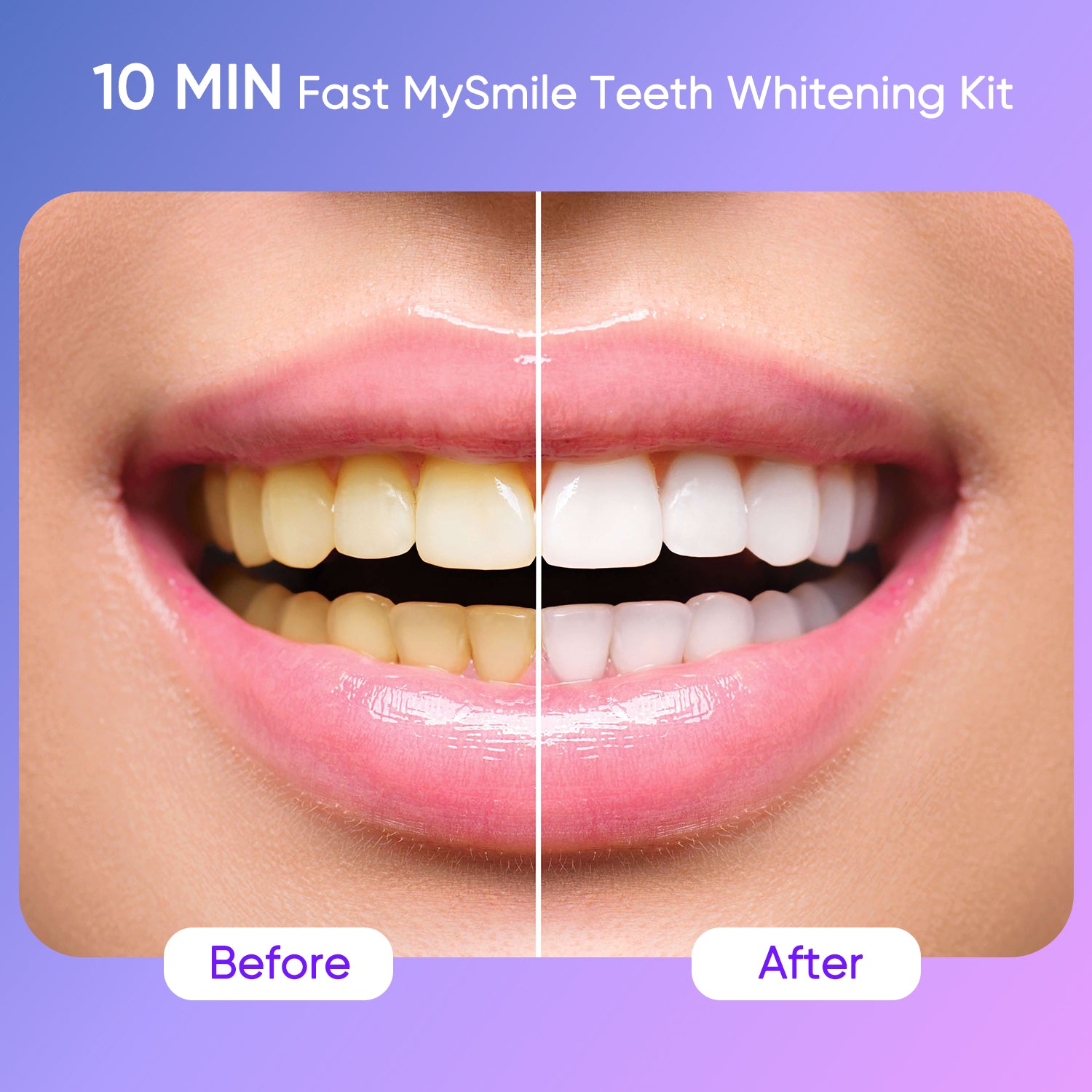 Teeth Whitening Kit - 10 Minute Fast Whitening, Before and After Results
