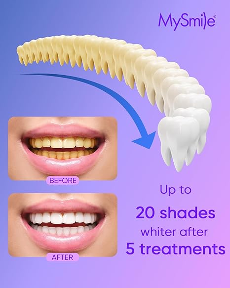 MySmile teeth whitening gel: Up to 20 shades whiter after 5 treatments