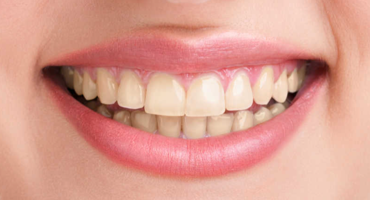 MySmile
