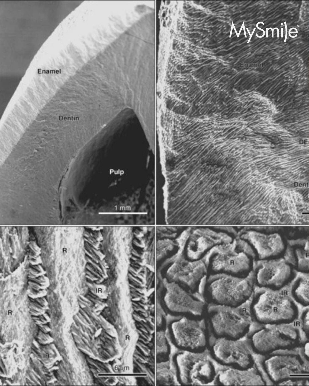 What Is Nano-Hydroxyapatite? A Dental Hygienist Explains Why It’s a Modern Alternative for Sensitive Teeth