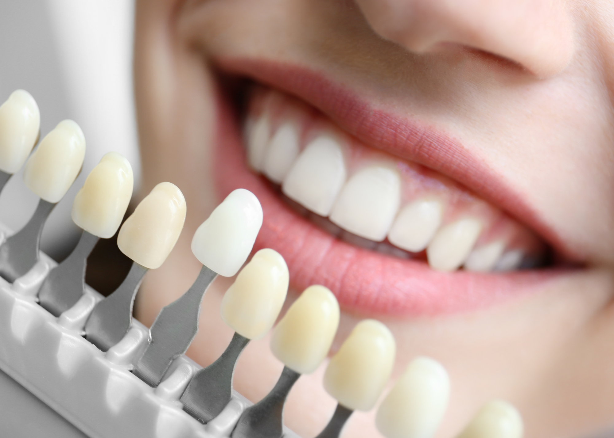 Pros and Cons of MySmile Teeth Whitening Strips