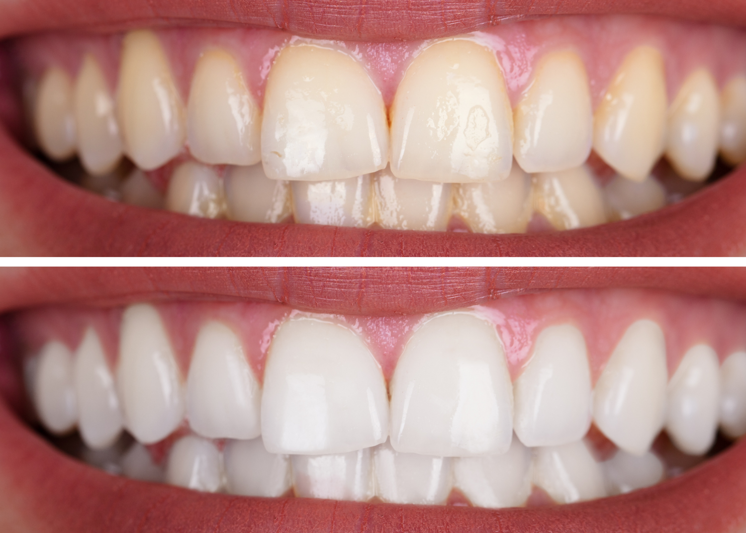 The MySmile V34 Whitening Process