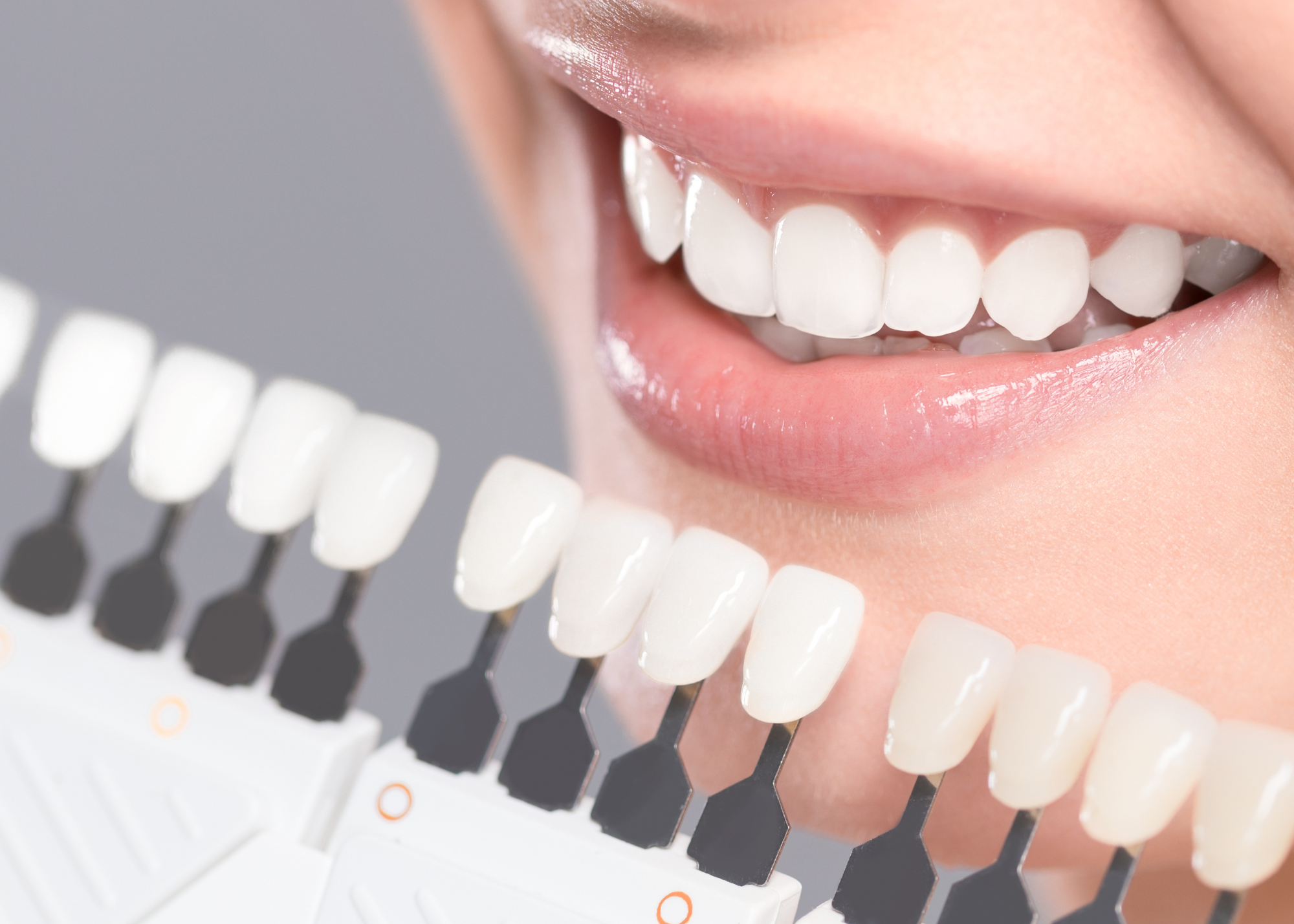 The Truth About Teeth MySmile Teeth Whitening Strips: What You Need to Know