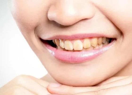 Why are my teeth yellow when I brush them everyday