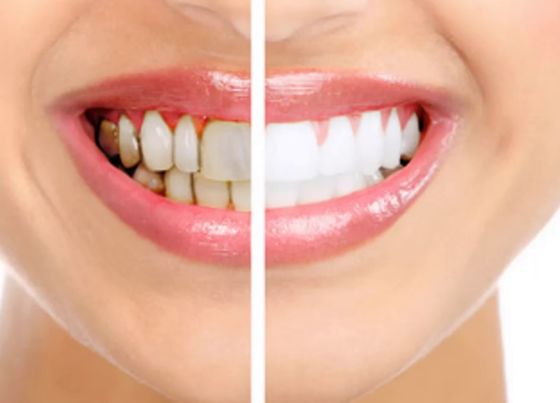 Black Lines on Teeth: Causes, Treatment Options, and More