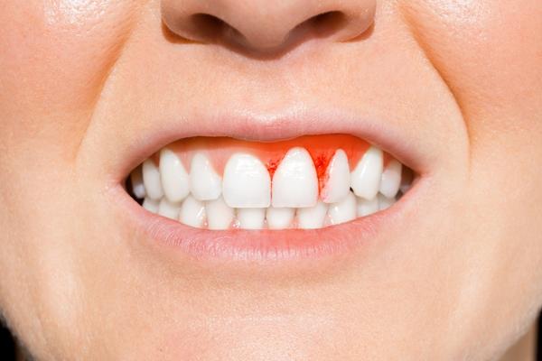 Bleeding Gums: Is it a Serious Condition? - MySmile