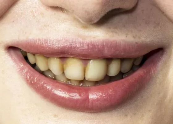 tips to remove brown stains from teeth naturally