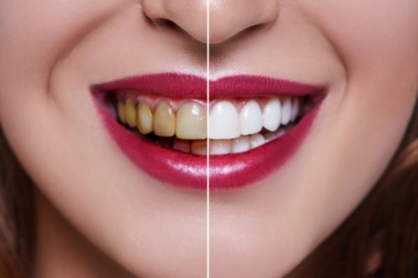 Get Perfectly White Teeth With These Easy Tips - MySmile