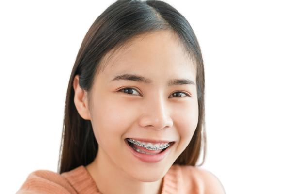 How to Ensure Your Braces-Wearing Smile Stays Bright and White - MySmile