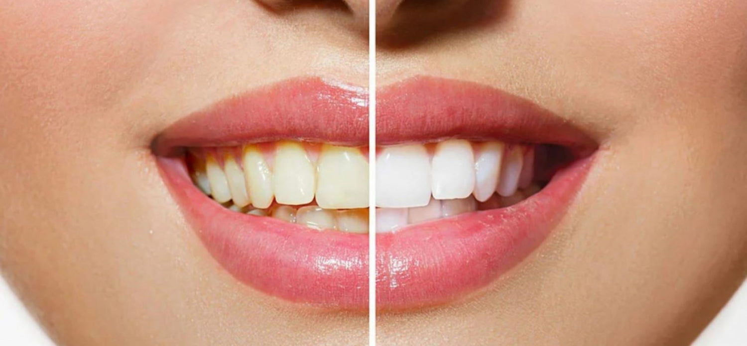 How To Fix Uneven Teeth Whitening (2025 Guide)