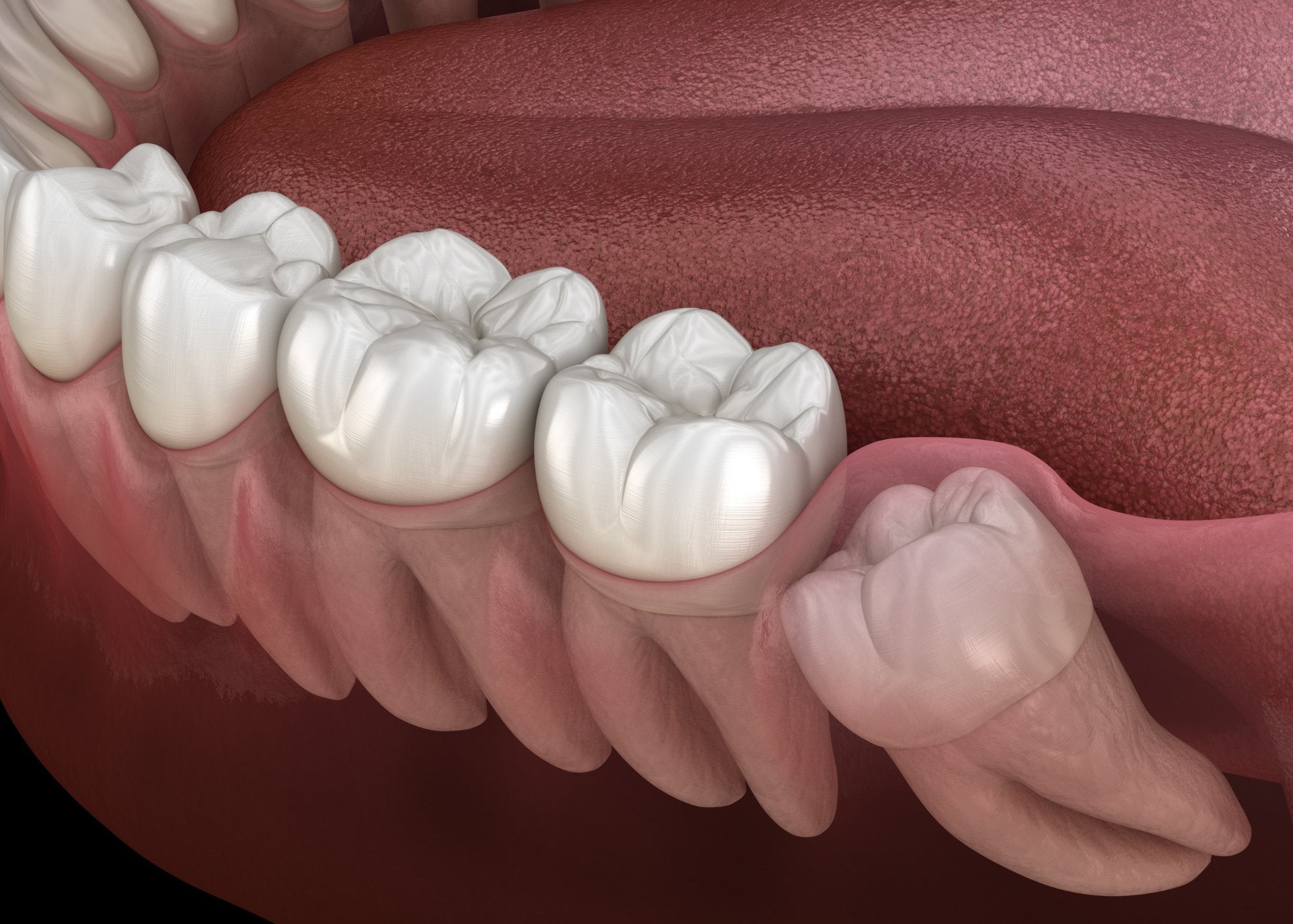 Impacted Tooth: What and Why it Happens - MySmile