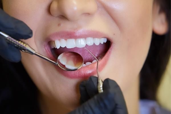 Reasons Why You Need Regular Dental Check-up - MySmile