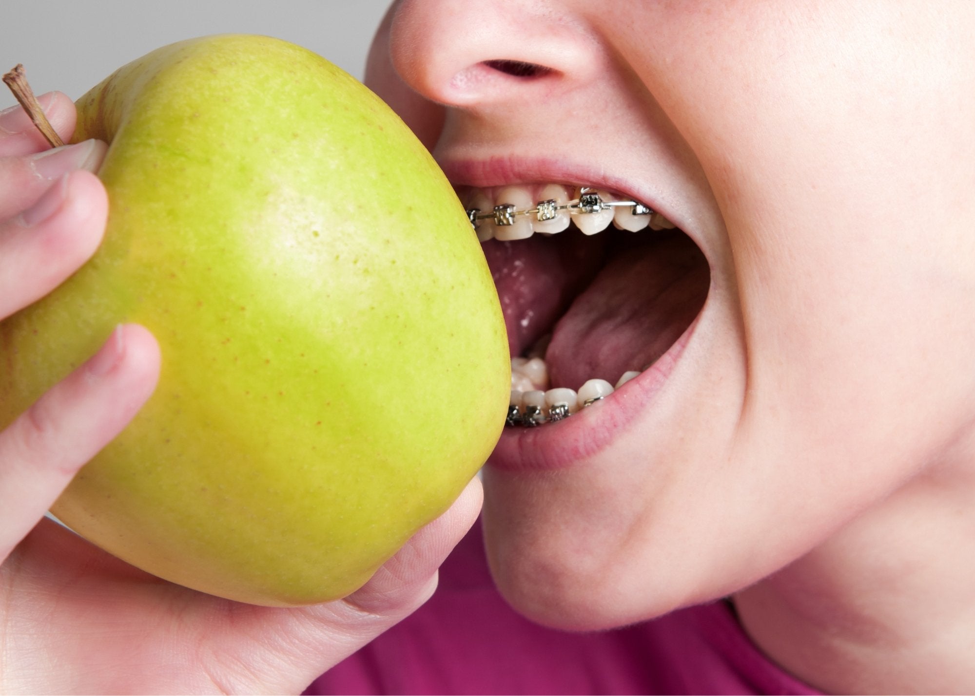 Tips to Eat Comfortably with Braces - MySmile