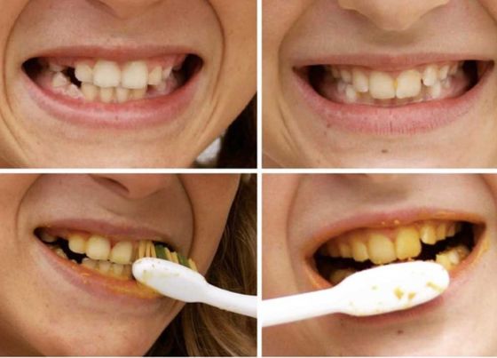 turmeric for teeth whitening