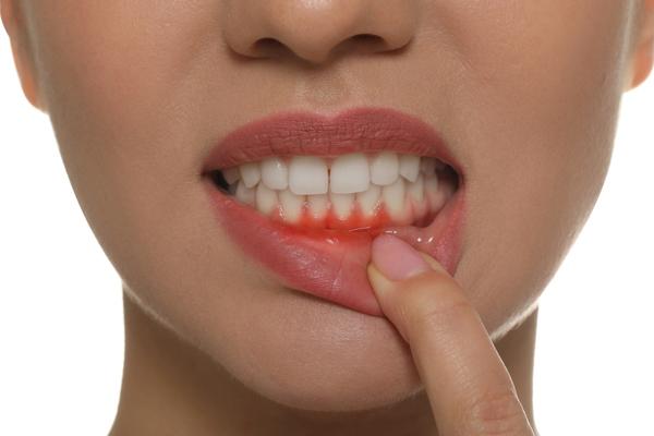 What Are Gums, And How Can You Protect It - MySmile