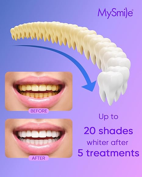 Ultimate Teeth Whitening Gel Refill 35%CP